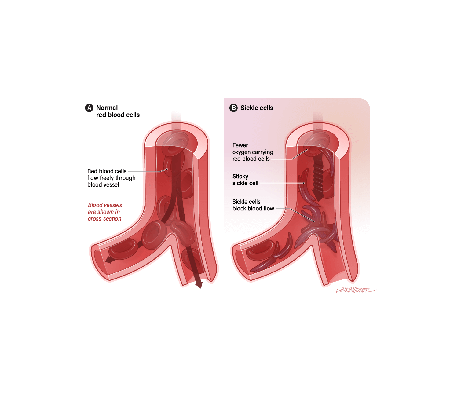 An illustration of two cross-sections for comparison; one shows healthy red blood cells in an artery while the other shows sickle-shaped red blood cells in an artery