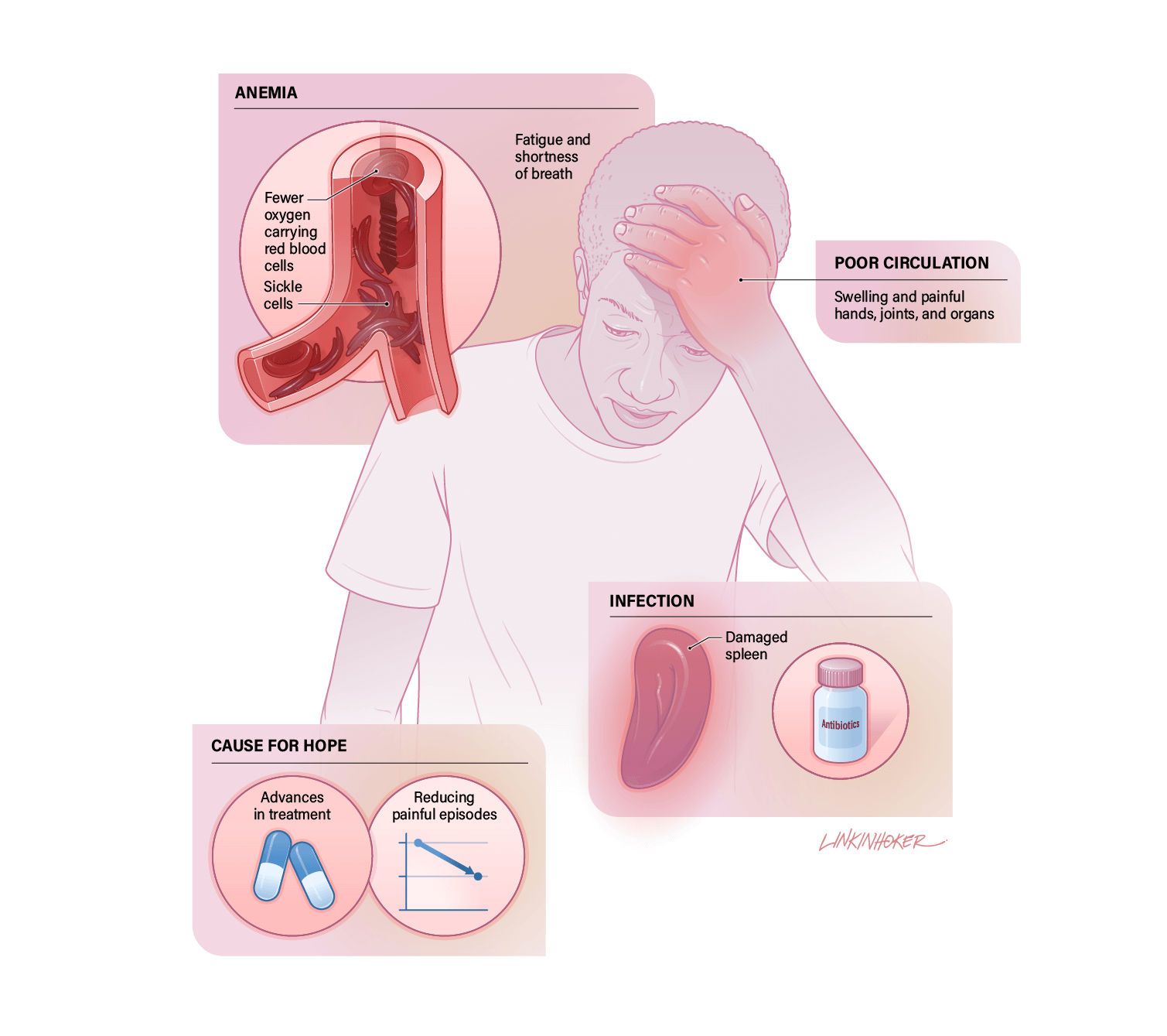 An illustration showing the complications of Sickle Cell Disease, including anemia, swollen joints, and infection