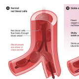 An illustration of two cross-sections for comparison; one shows healthy red blood cells in an artery while the other shows sickle-shaped red blood cells in an artery