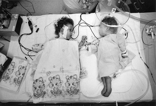 A photograph of the separated twins in intensive care, one awake looking at the other asleep.