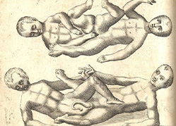 An illustration of two different sets of twin children joined at the pelvis.