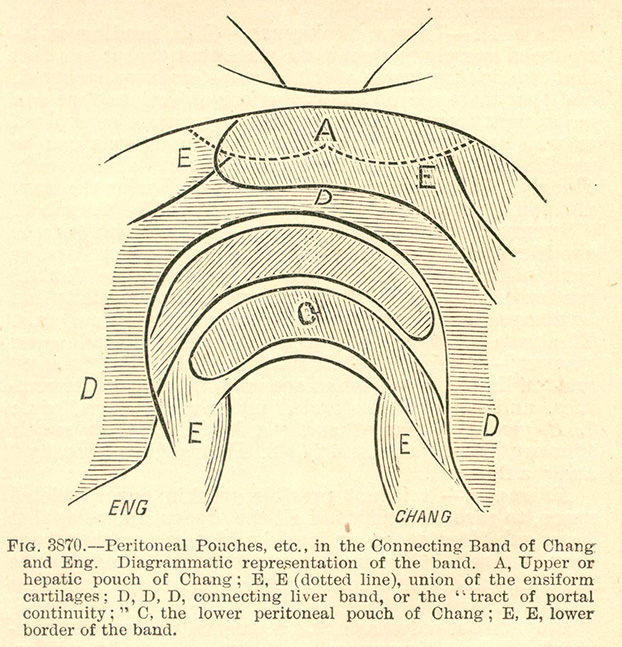 Nineteenth century illustration detailing the peritoneal and hepatic pouches and ensiform cartilages in the connecting band of Chang and Eng Bunker.