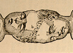 An illustration of two infants joined at the top of their heads.