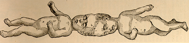 An illustration of two infants joined at the top of their heads.