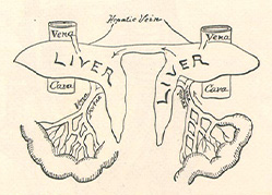 Nineteenth century illustration of Chang and Eng Bunker’s livers and shared hepatic vessels, showing how an injection into Chang passed into Eng.