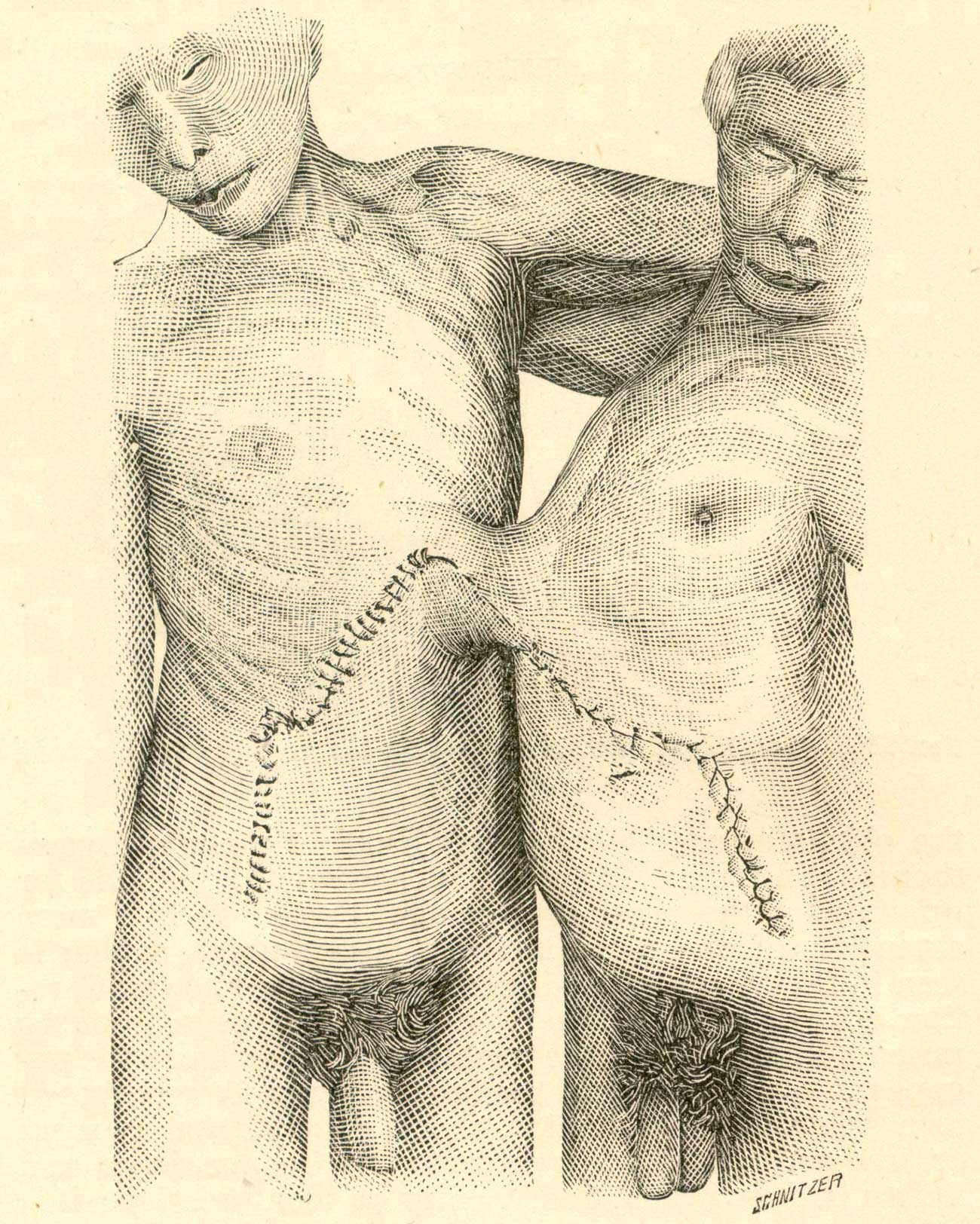 A woodcut of two naked men joined by a small connected area at the base of the ribcage.