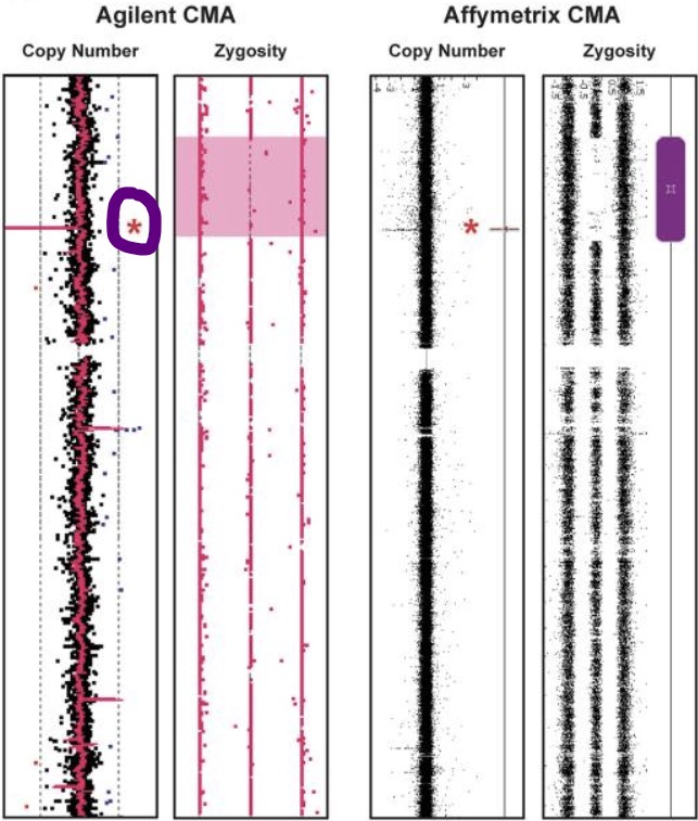 Chromosomal microarray test result graphic. Highlights a point of missing DNA near the BBS9 gene.